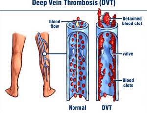 thrombosis 2