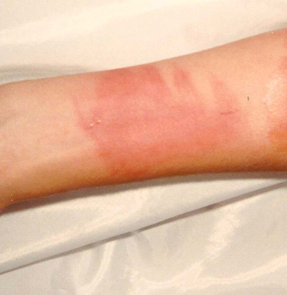 what does a 1st degree burn look like